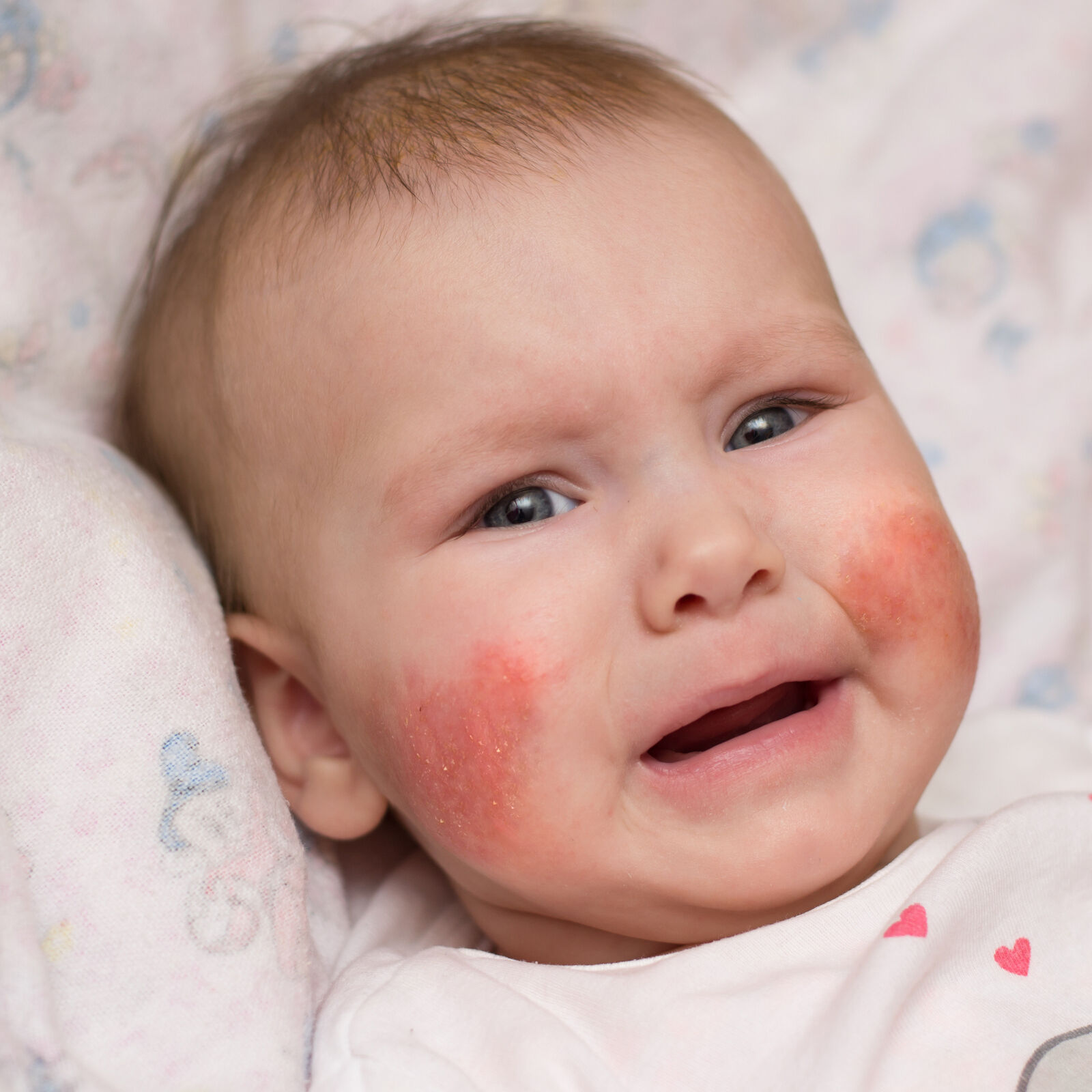 How to choose the right products for baby with dermatitis